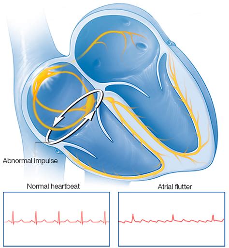 what is a atrial flutter ablation