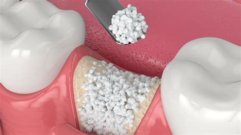 what is a bone replacement graft