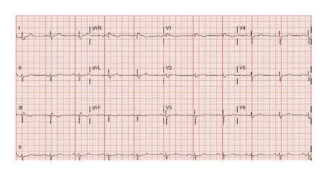 what is a borderline ecg