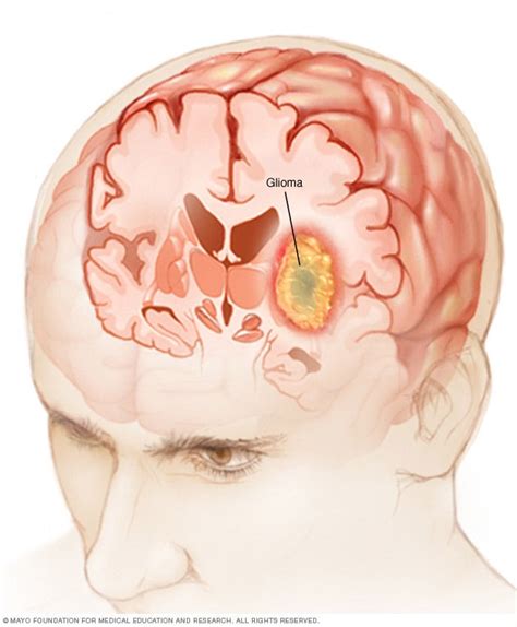 what is a brain glioma