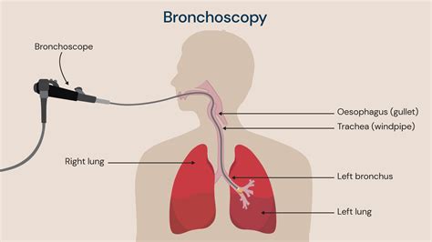 Understanding What is a Bronchoscopy: A Guide to the Procedure and Its Benefits