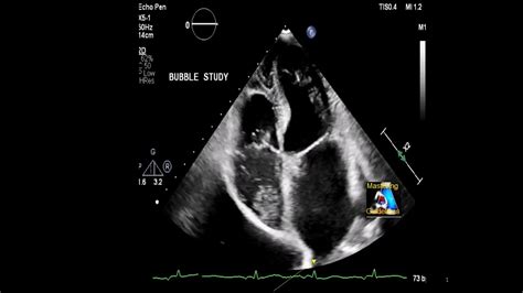 What Is A Bubble Heart Test