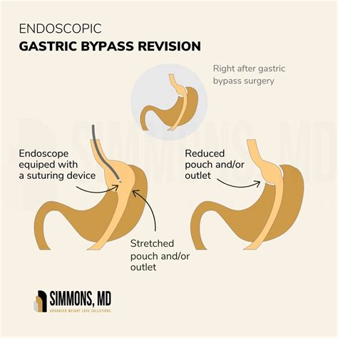 What Is A Bypass Revision