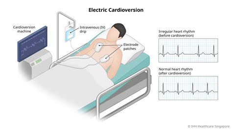 Understanding Heart Rhythm Restoration: What is a Cardioversion?