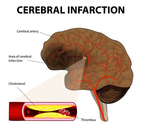 what is a cerebral infarction definition