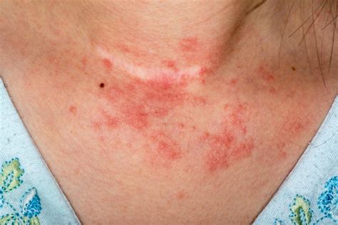what is a chest rash a symptom of