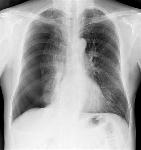 Understanding What is a Collapsed Lung: Causes and Symptoms