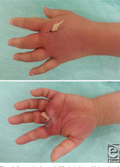 What Is A Collar Button Lesion