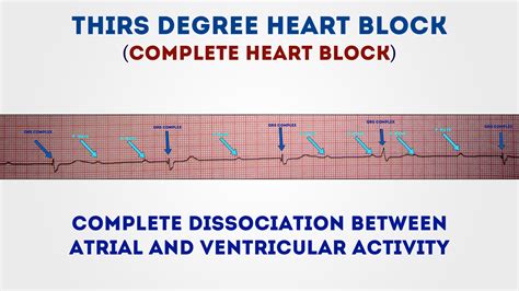what is a complete heart block