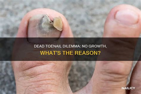 What Is A Dead Toe