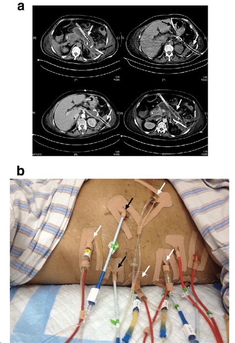 What Is A Double Catheterization