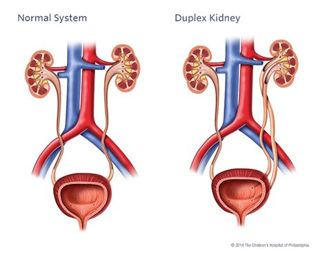 what is a duplex kidney