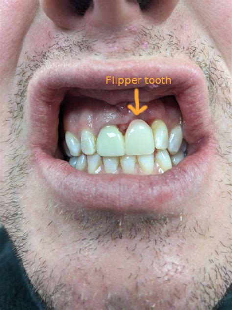 What Is A Front Flipper Tooth
