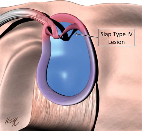 what is a glenoid labrum tear