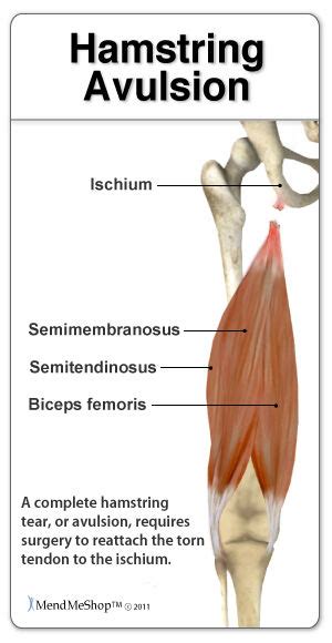 What Is A Hamstring Avulsion