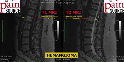 what is a hemangioma of the spine