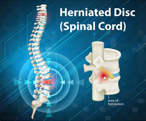 What Is A Herniated Disc In Your Lower Back