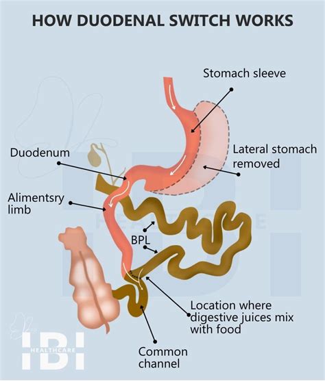 What Is A Loop Duodenal Switch