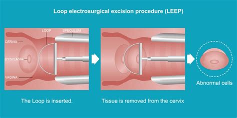 what is a loop procedure