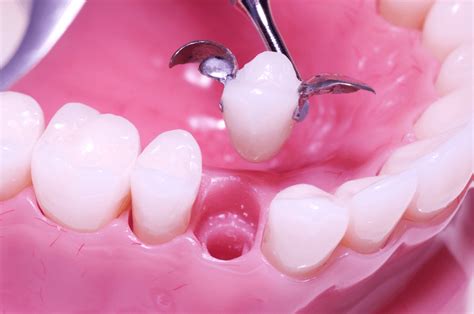 what is a maryland bridge in dentistry