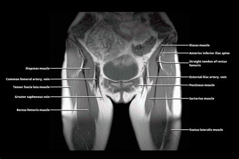 What Is A Mri Of The Pelvis