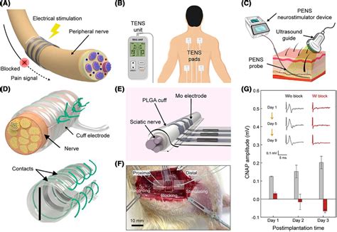 What Is A Nerve Conduction Block