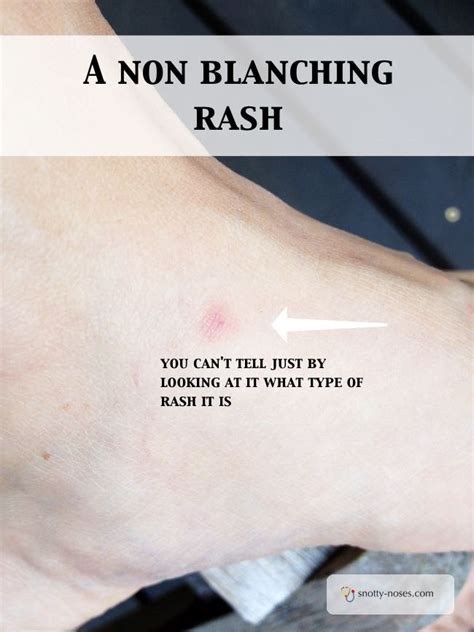 what is a non blanching rash