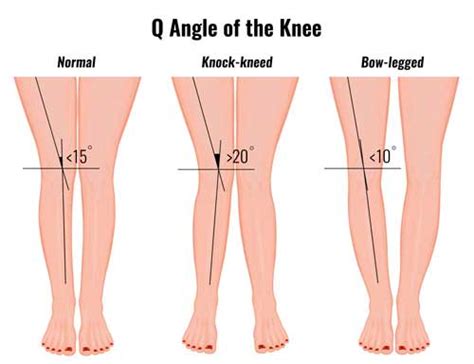 What Is A Normal Q Angle