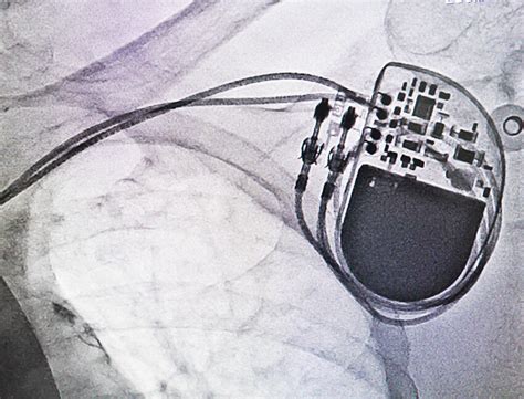 What Is A Pacemaker Device Check