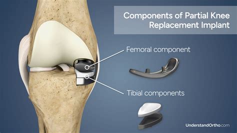 What Is A Partial Knee Replacement Surgery