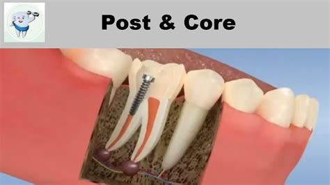 what is a post and core root canal