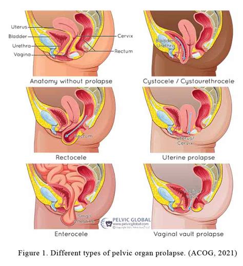 Understanding Prolapse: What is a Prolapse and Its Implications