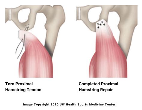 What Is A Proximal Hamstring Tear