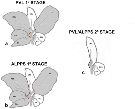 what is a pvl procedure