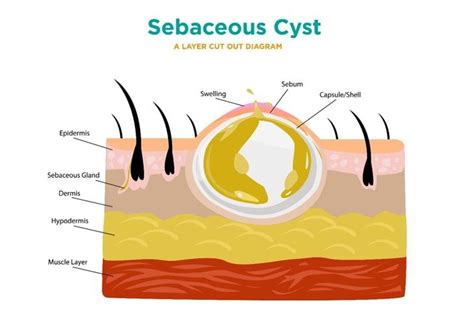 what is a sebaceous cyst on back