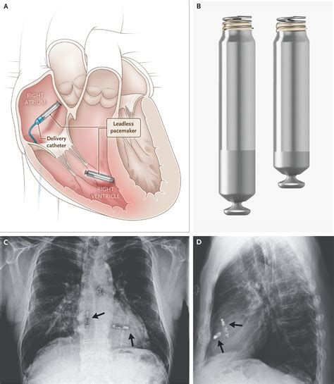 What Is A Shielded Pacemaker