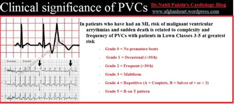 what is a significant number of pvcs