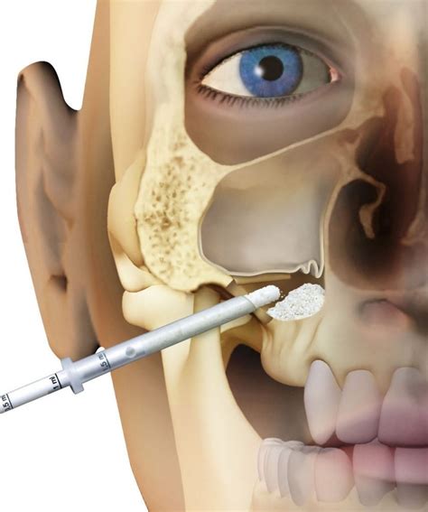 what is a sinus lift dental implants