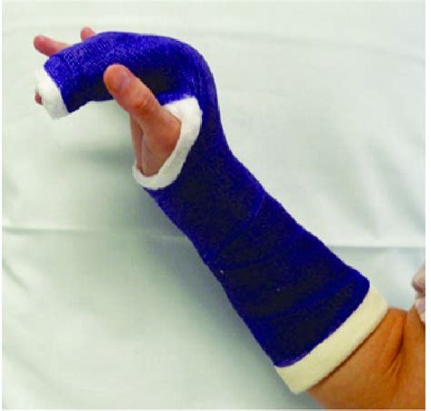 What Is A Splint Cast