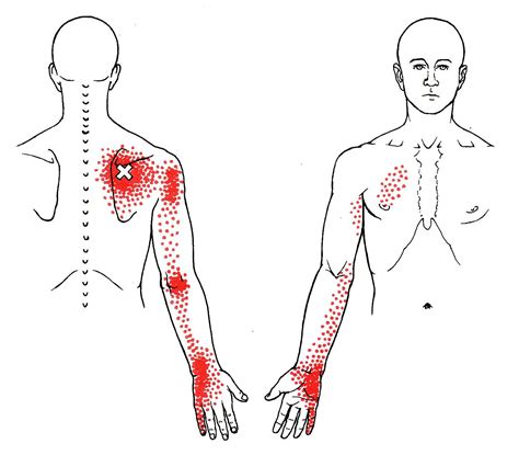 What Is A Trigger Point In Shoulder