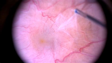 what is a vitrectomy with membrane peel