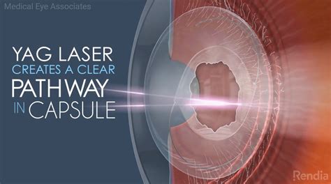 what is a yag laser surgery