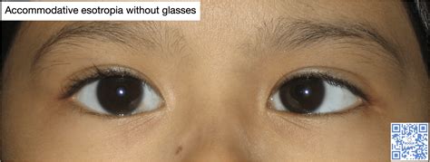 what is accommodative esotropia