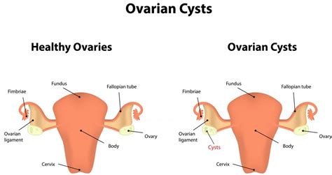 what is adnexal mass