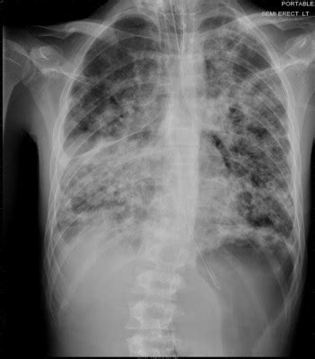 what is airspace disease in lung