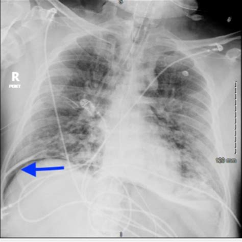 what is airspace disease on chest x-ray