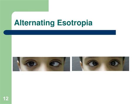 what is alternating esotropia