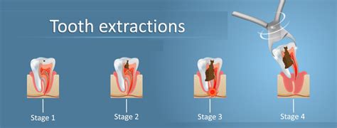 Tips for Tooth Extraction Medicine Bellevue Pharmacy