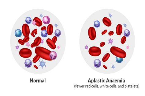 what is aplastic anemia caused by