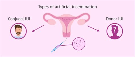 what is artificial insemination technique